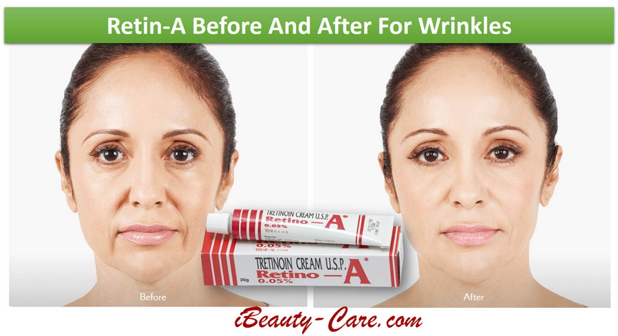 retin-a wrinkles before after