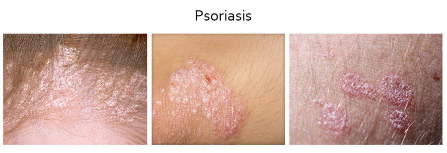 Psoriasis problems