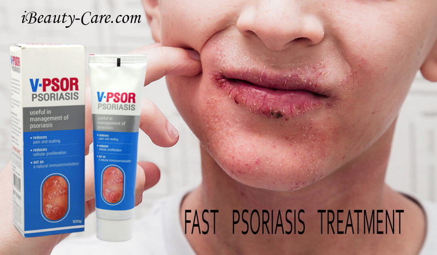 facial psoriasis treatment