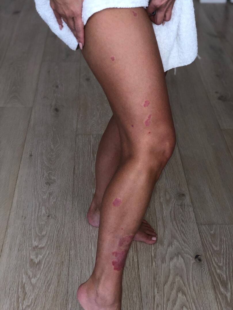 kim kardashian legs psoriasis